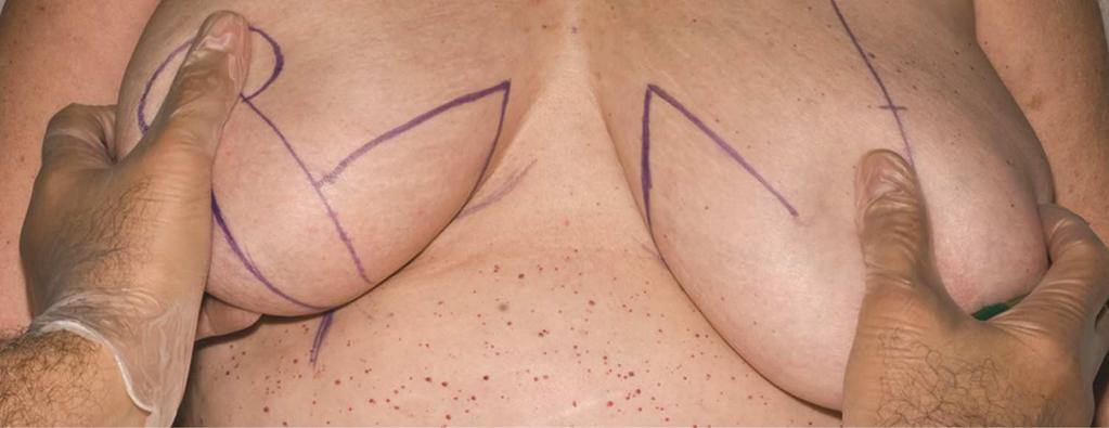 Technique With this medial marking now symmetrical on the left breast the