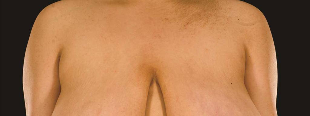 Plastic Surgery: An International Journal 4 that this technique may be usefully applied with very good results in both mastopexy and in therapeutic mammoplasty for larger breasts.