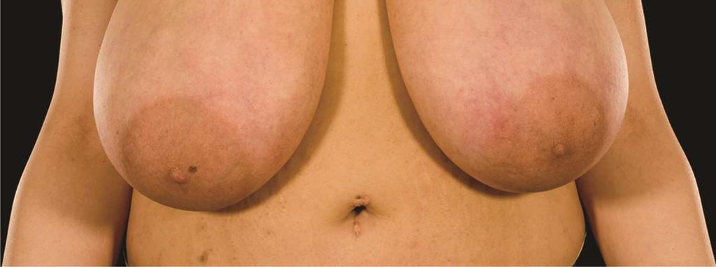 Figure 6: (A) Preoperative Photograph for Another Patient Undergoing a Bilateral Breast Reduction Using the Cleavage Imprinting Technique.