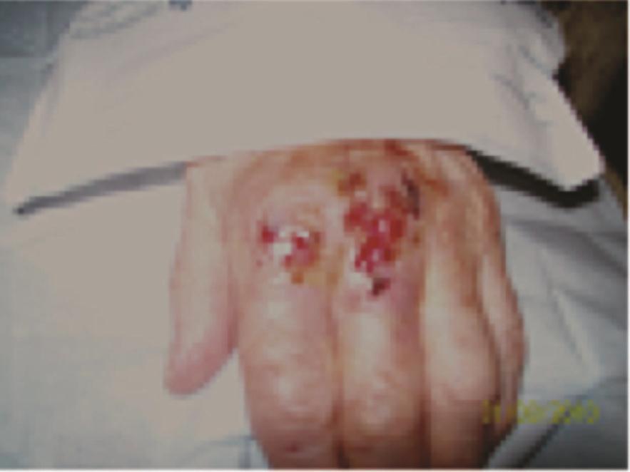 Case study 3 86 year old man Sustained hand injury due to