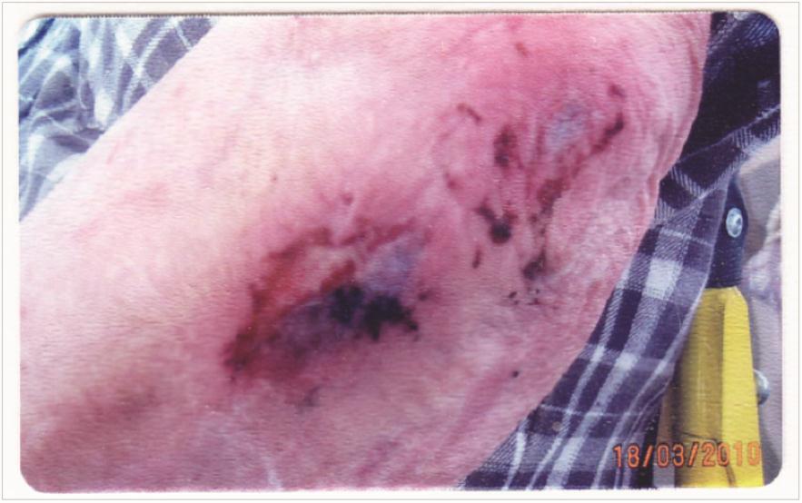 Case study 3 77 year old man Previously suffered from cancer Skin tear on elbow