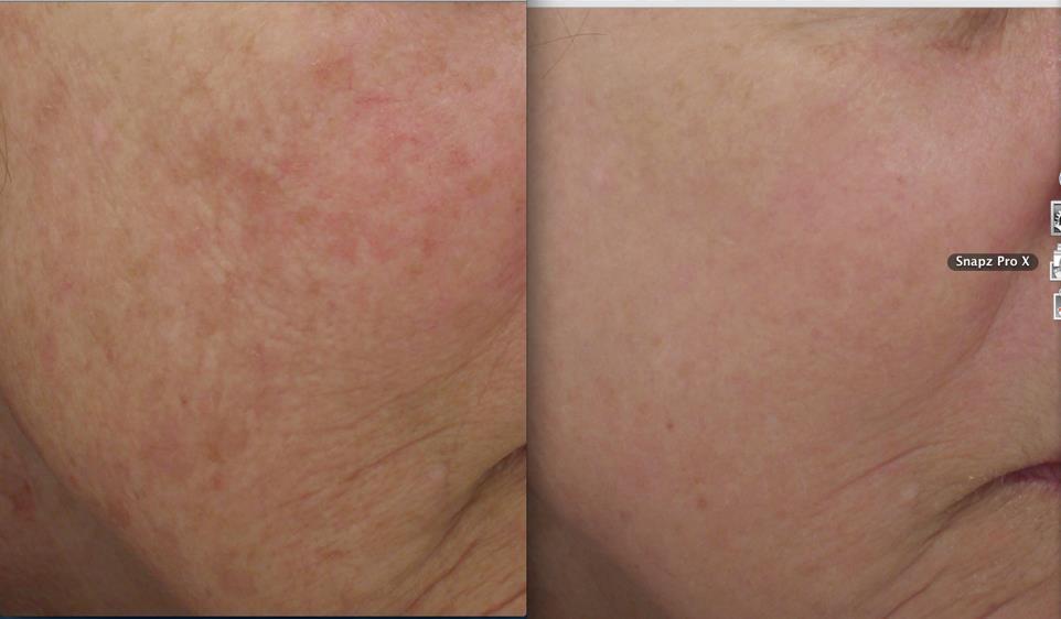 Before After 1 Treatment Photos