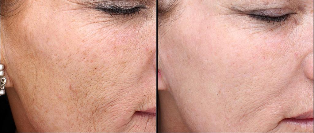 Before PORE IMPROVEMENT After 2 Treatments