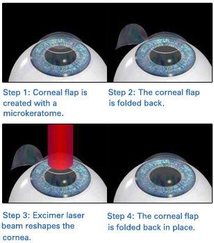 Laser Eye Surgery Systems LASIK starts with cutting back a