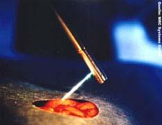 Lasers in Medicine Medical applications one of fastest growing laser