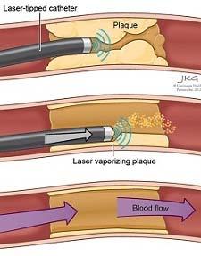 Bypass & Stroke Prevention problem is build up of plague Artery reduces Artery size, causes stroke Fiber inserted