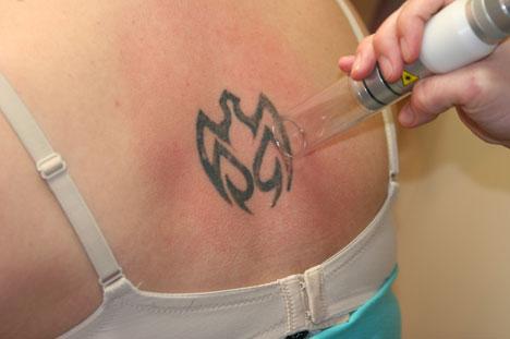 Laser Tatoo Removal Laser tattoo removals: done with Nd:Yag Nd:Yag Near IR light penetrates skin to tattoo depth Near IR strongly absorbed by dye: bleaches