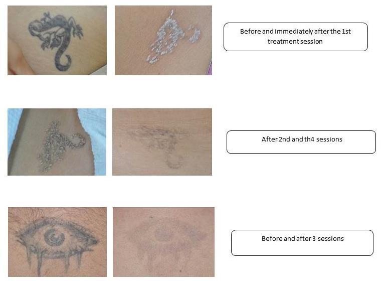 Results Average % of removal: 1. 1st session 40% 2. 2nd session 30% 3. 3rd session 20% Total 80% tattoo removal. Treatment session time depends on tattoo's size and pattern.