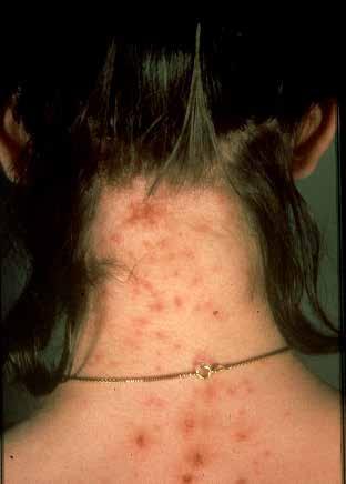 Head Lice infestation (pediculosis) is still a major problem especially in schools. 100.