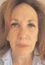 Melissa Age 64 Before After What is a QLift and what aging areas are treated? The QLift procedure is a short-scar facelift that is performed in the office.