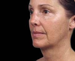 GROSS If you have mild sagging in the center of your face (cheeks) TARGETS THE CHEEKS MID-FACELIFT The midface/cheek area is key in the formula for a more youthful appearance.