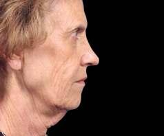 GROSS Excess or sagging facial skin Deep facial creases Redistributed facial fat pockets FOR MAXIMUM REJUVENATION ENHANCE YOUR RESULTS WITH A NECKLIFT In many cases, a necklift is performed in