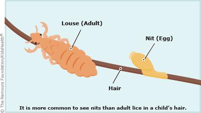 Adult lice and nymphs (baby lice). The adult louse is no bigger than a sesame seed and is grayishwhite or tan. Nymphs are smaller and become adult lice about 1 to 2 weeks after they hatch.