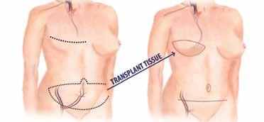 2. Autologous Free Flap Using your own tissue to make a new breast shape. In this type of reconstruction, you are borrowing or transplanting tissue from another part of your body to create the breast.