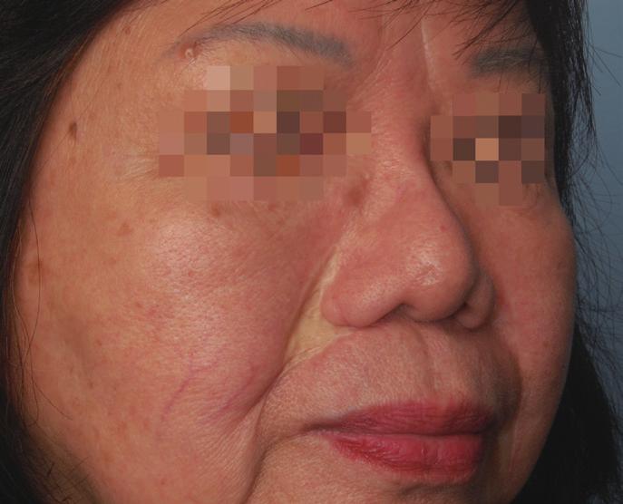 The flap was later folded over on itself to complete the reconstruction of the external alar rim. Six weeks later, the patient underwent bilateral nasolabial fold scar revision.