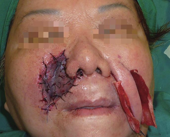 Case 2 A 44-year-old woman (patient 3) was diagnosed with a left-sided olfactory neuroblastoma involving the orbit, nasal cavity, maxilla, and anterior cranial fossa.