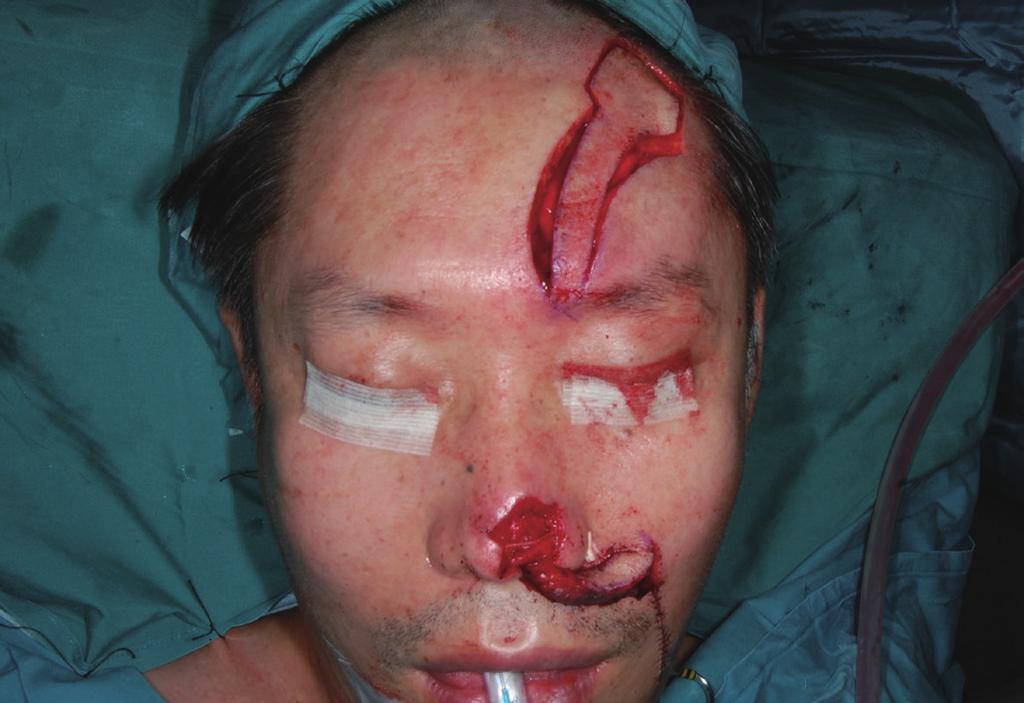 The flap tip was inserted into the nostril using the skin of the flap to reconstruct the internal