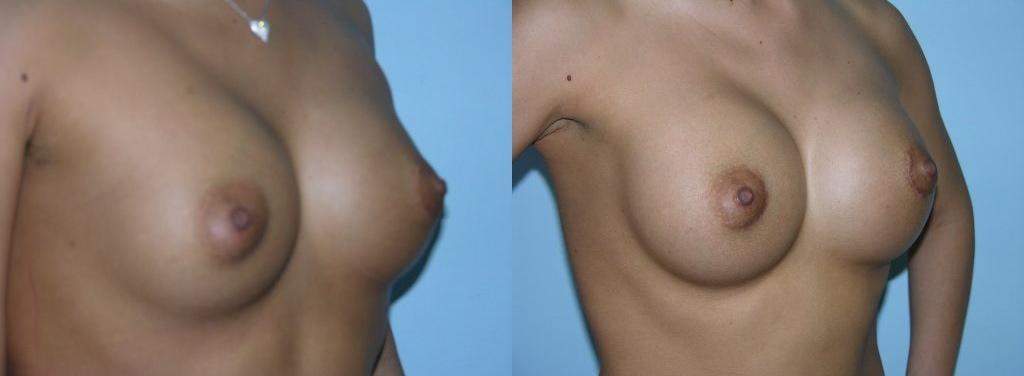 A breast lift is a surgical procedure designed to raise and reshape the breasts by removing excess skin and tightening the surrounding tissue.