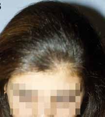 Beard and moustache alopecia (Figure 15) can be the result of scarring after injuries such as burn, car accident, acne, or cleft lip (25).