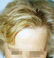 The three Ludwig stages are: Stage 1 = moderate thinning of the vertex Stage 2 = more significant thinning with a persistence of the frontal anterior fringe Stage 3 = nearly complete baldness of the