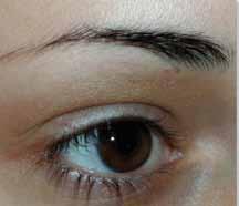 hair research ARTICLE References Figure 20 Eyebrows alopecia (a) one day after one session of follicular unit long hair (b).