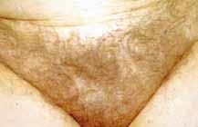 Multifactorial classification of male and female androgenetic alopecia. Dermatol Surg. 2000; 26(6): 555 61 5. Bouhanna P. New aspects of Minoxidil. Le minoxidil : qu en penser à l heure actuelle?