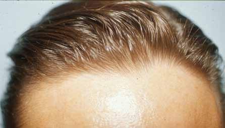 The number of testosterone receptors of the follicular cells and the activity of the 5-alpha-reductase enzyme in different areas of the scalp are increased.