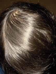 The efficacy and the safety of 2% minoxidil lotion as a form of treatment of female AGA was proved in a 32-week double-blind study conducted versus placebo (7).