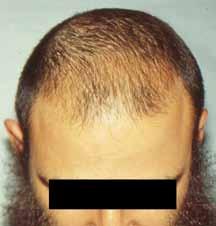 hair research ARTICLE was found to reverse miniaturisation over an 8-month period when compared to a control. This procedure is still under investigation.