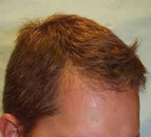 All the methods described in this article are not only for the treatment of male and female pattern baldness, but also for alopecia caused by traumatic injury, second and third degree burns,