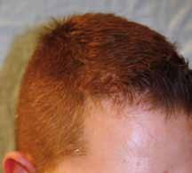 The choice of follicular unit transplantation technique will depend on the degree and location of the alopecia, as well as the age and ethnic considerations of the patient.