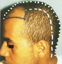 Figure. 9 (a) Frontal androgenetic alopecia (21 years). Before treatment median sagittal = 37 cm, and parasagittal = 31 cm (Hamilton V).