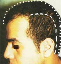 5 cm (Hamilton III) Type Ia Frontal recession 1000 hairs in one or two sessions Implantation Type Ib Frontal recession and crown alopecia 2000 3000 hairs in one or two sessions Figure 10 Transplanted