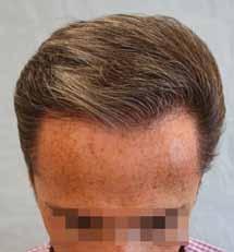 obliquities, an irregular and fine frontal hairline with hair done oneby-one with 1000 4000 hairs per session. These refinements can be carried out using a final stick and place technique.