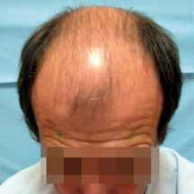 The use of a 2% minoxidil solution before and after hair transplantation will reduce the postoperative hair-loss and improve the transplanted hair regrowth (22).