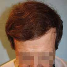 female pattern baldness and AGA, but that have fewer indications and efficacy, including: 2 mm punch-transplants harvested with a power punch.