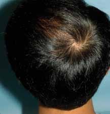The FUT indications for these types of male baldness are : For stage 1: a = 1000 hairs (Figure 11); b = 2000 3000 hairs in 1 2 sessions (Figure 12) For stage 2: a =
