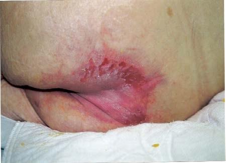 Moisture Associated Skin Damage follow.
