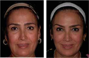 Strategy 1: Understand Facial Ideals The ideal female face has the shape of a heart or inverted triangle, with a prominent upper face and mid face tapering to a less prominent lower face.