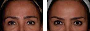 Oculi), to shape the eyebrows (Corrugators, Procerus, Orbicularis Oculi), and to open the eyes (Orbicularis Oculi). Dysport dosages.