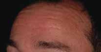 Both patient and author noted fewer residual lines immediately above the middle and lateral one-thirds of his eyebrows (arrowed) after abobotulinumtoxin A than after previous BoNT-A (Botox Cosmetic).