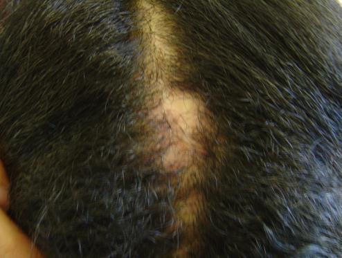Hair loss Traction Alopecia Njibhabha - worse with