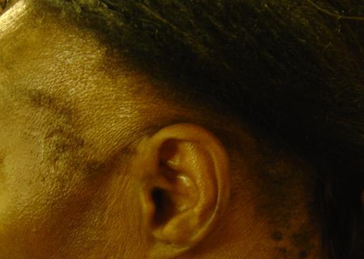 Scarring Alopecia (CCCA) contribution of relaxers 6.