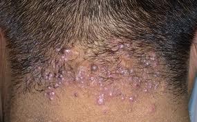 Whilst administering questions investigating haircut symptoms: itch, transient pimples,