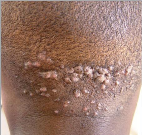 2 nd study of 390 HIV +ve participants h/o bleeding 25% NB: >bleed with chiskop haircuts
