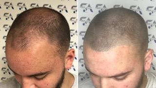 MICROPIGMENTATION For MEN Many clients want to run along the line they have receded to over time and just give a full through the rest of the hair.
