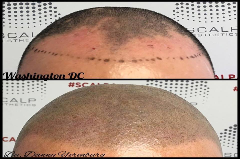 ALOPECIA Types of Alopecia Androgenic alopecia This condition refers to male pattern baldness, the most common cause of hair loss in men.