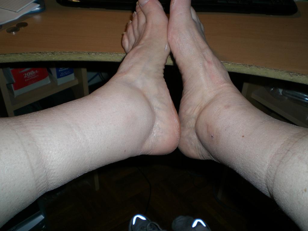 Swelling in ankles and feet