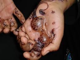 8 Blistering reaction to black henna 9 A blistering reaction to black henna will be followed by future allergic reactions from further contact with consumer products containing diamines and other