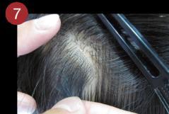 Apply the prepared HAIR CONTACT to the bald scalp area carefully, making sure not to place on existing hair.